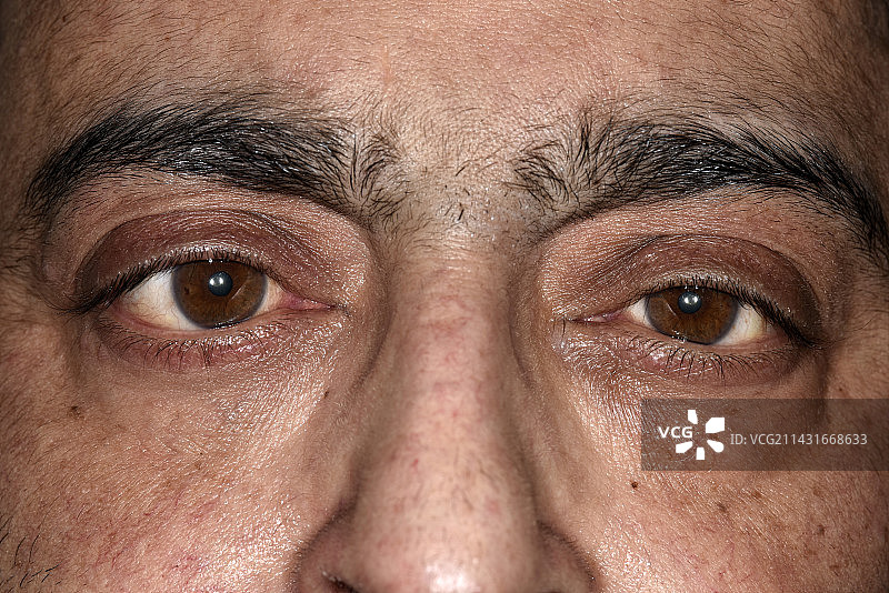 动眼神经麻痹引起的斜视图片素材