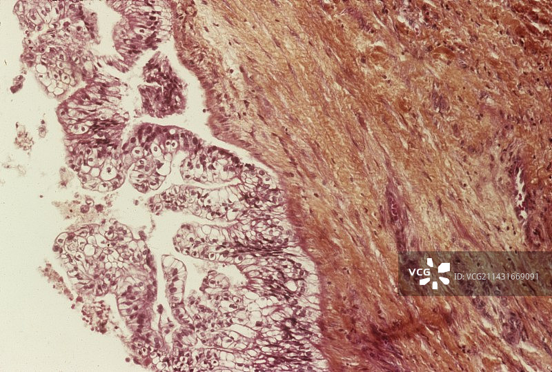 胰腺癌，光学显微照片图片素材