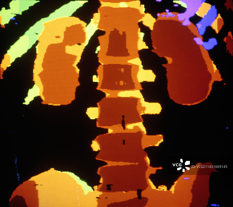 显示健康肾脏的彩色CT扫描图片素材