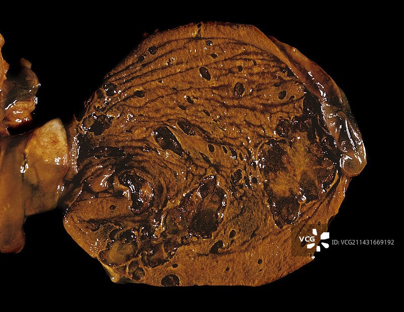 坏疽性胆囊图片素材