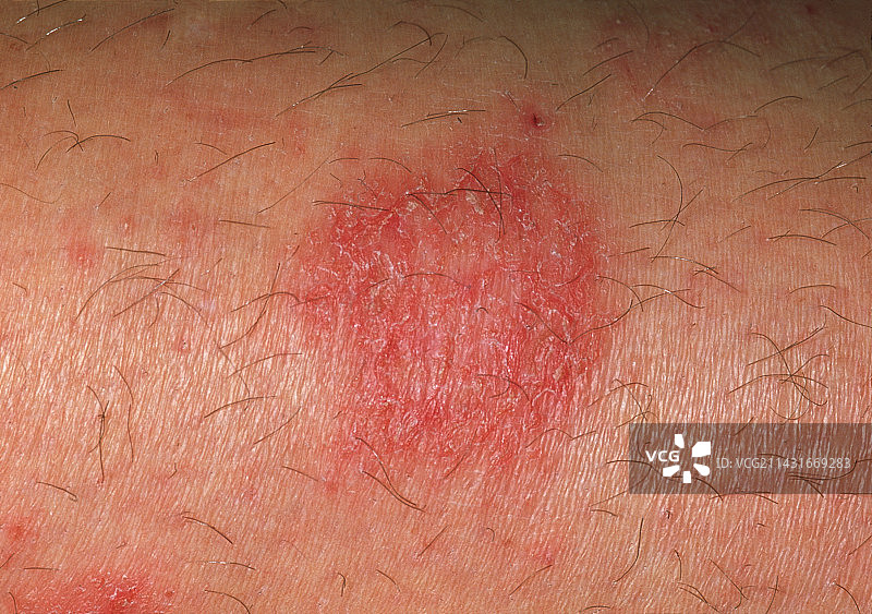 药物过敏图片素材