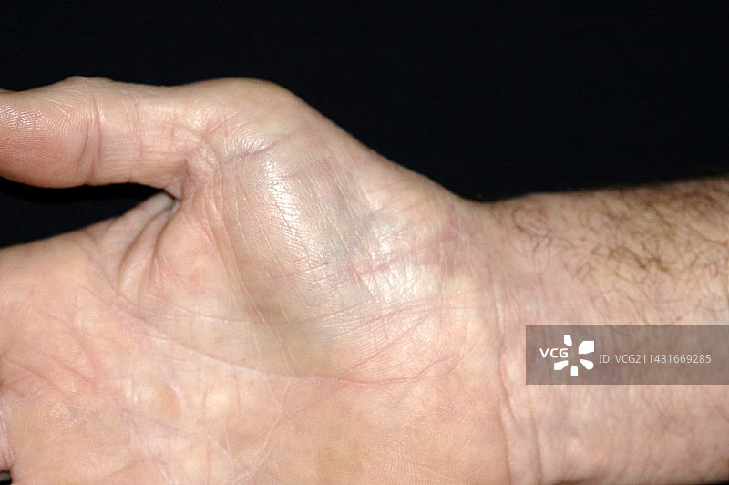 肌肉萎缩图片素材