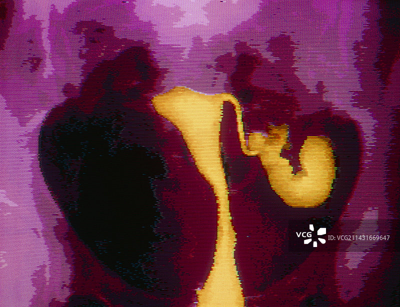 不孕不育：X光显示输卵管堵塞图片素材