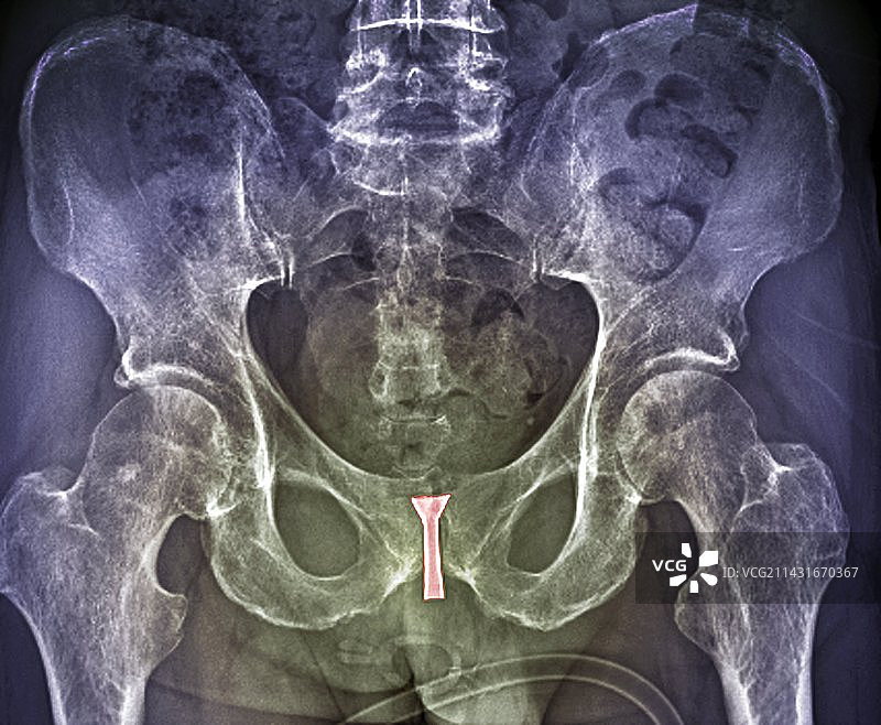 尿道支架X光片图片素材