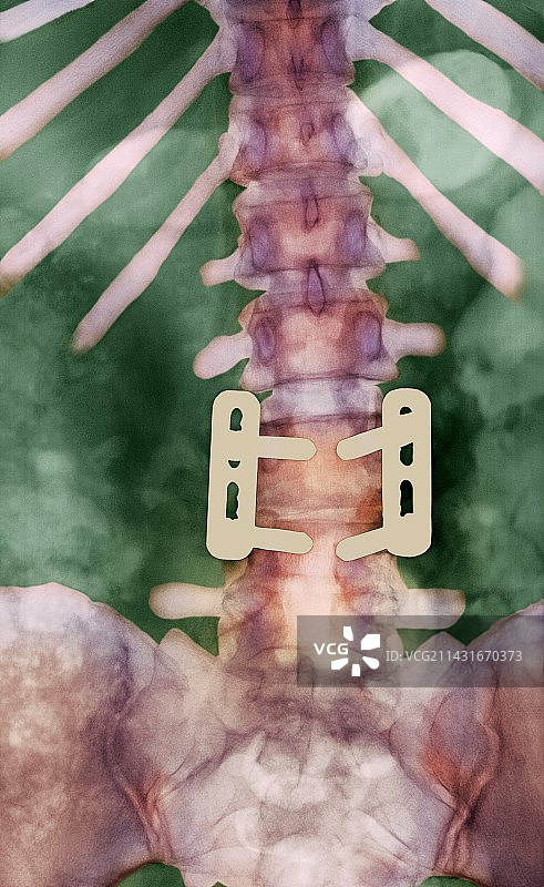 脊椎X光片图片素材