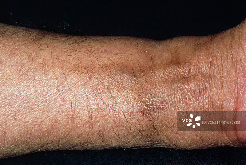 化疗后男子手腕上的色素沉淀图片素材