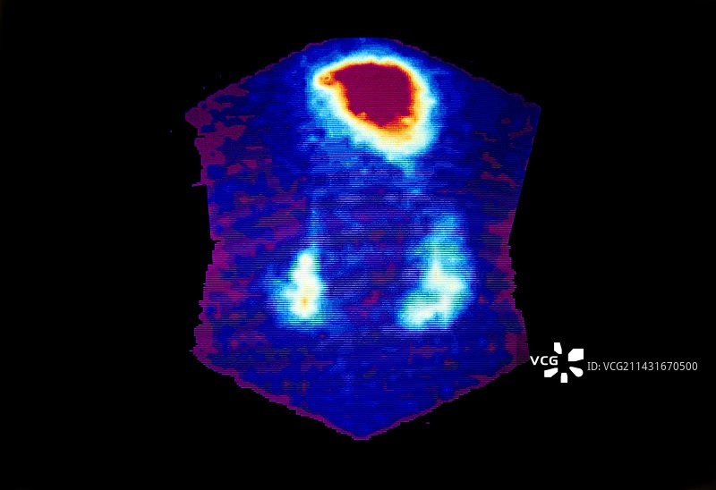 显示尿液反流至肾脏的彩色伽马扫描图片素材