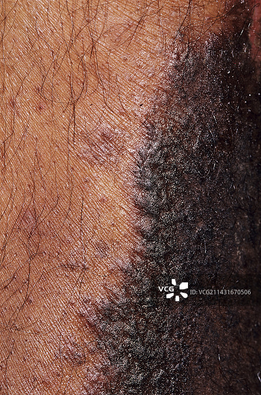 牛皮癣图片素材