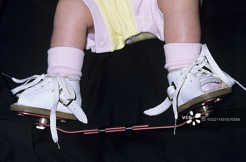 clubfoot图片素材