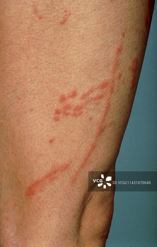 接触毒橡树引起的皮炎，出现皮疹图片素材