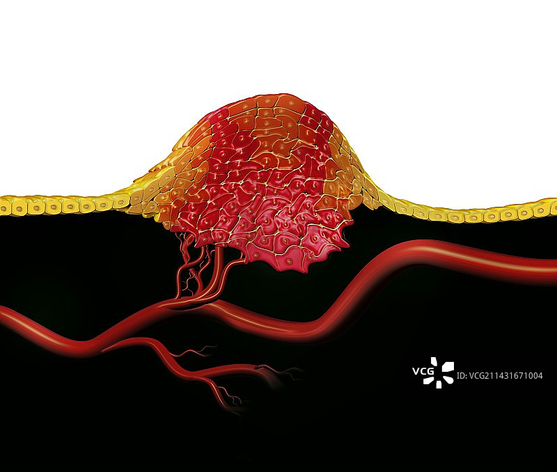 肿瘤，艺术作品图片素材