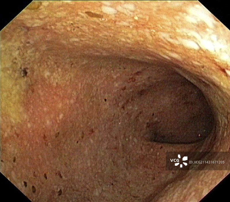 溃疡性结肠炎图片素材