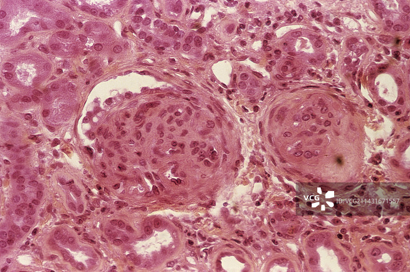 肾脏炎症光学显微照片图片素材