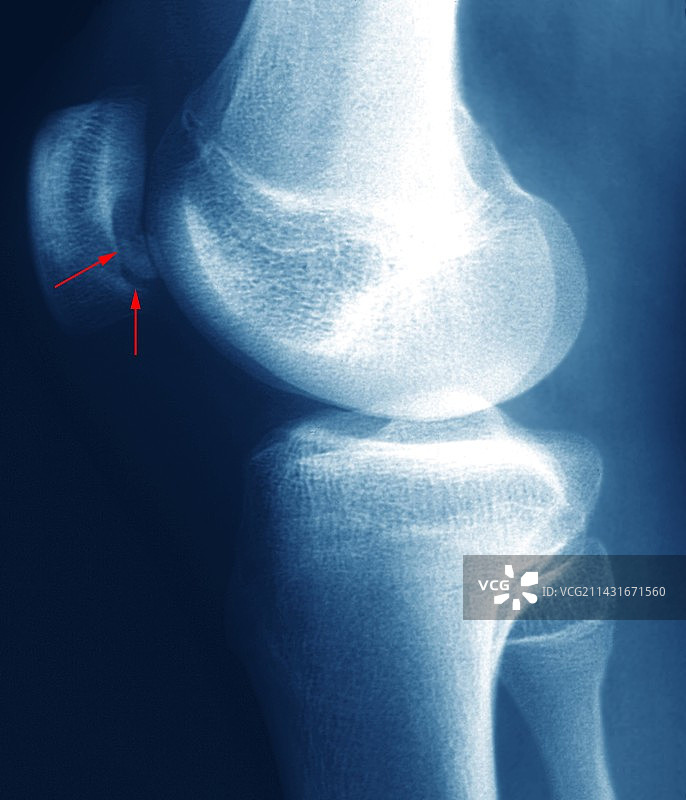 膝关节疾病图片素材
