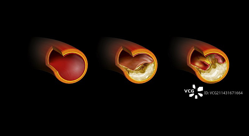 动脉粥样硬化的发展过程图片素材