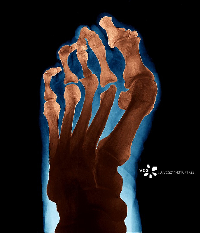 关节炎足部X光片图片素材
