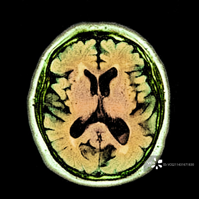 酒精性痴呆症MRI扫描图片素材