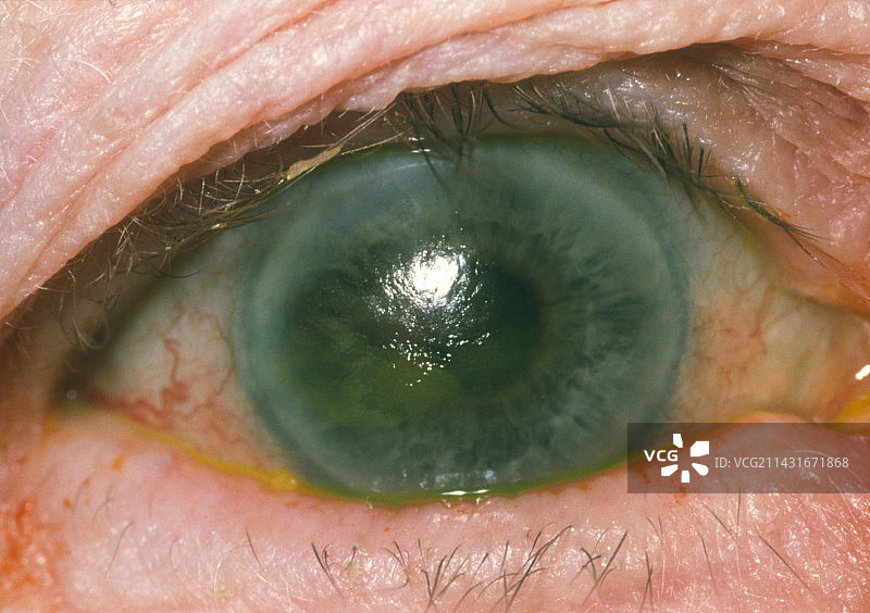 角膜营养不良图片素材