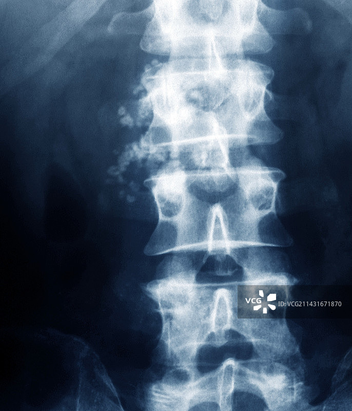 慢性胰腺炎X光片图片素材