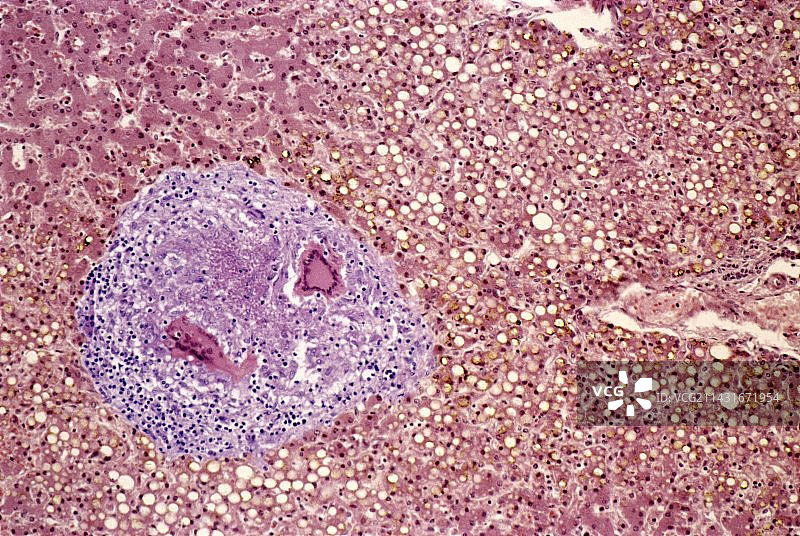 肝结核，光学显微照片图片素材