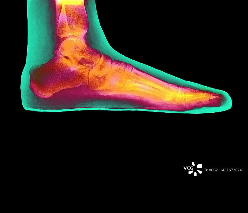 女性扁平足的彩色X光片图片素材