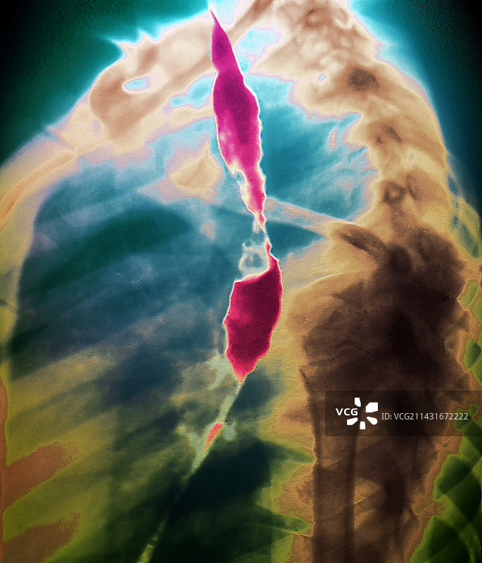 食道狭窄X光片图片素材