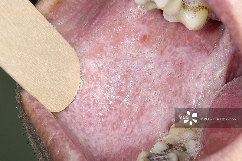 口腔扁平苔藓图片素材