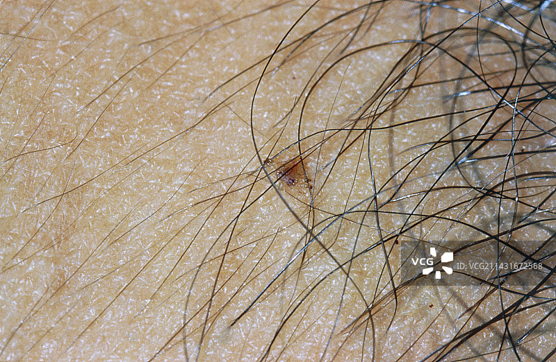 附着在人发上的阴虱图片素材