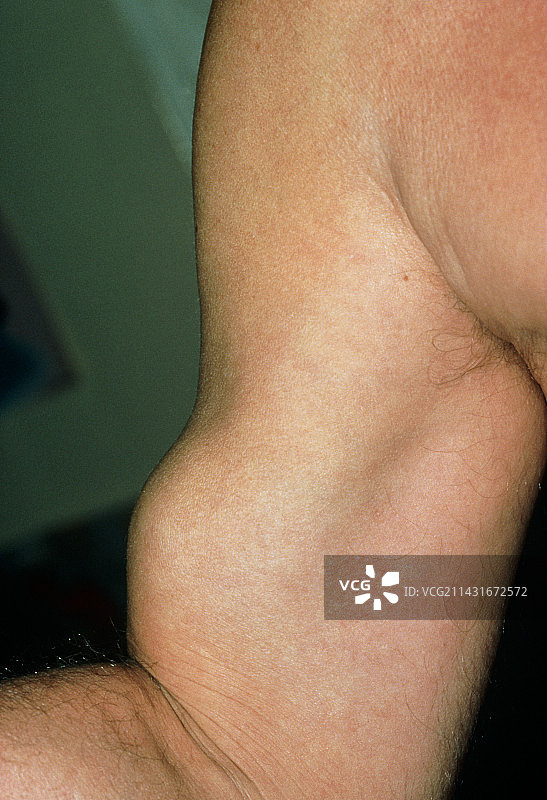 男性右肱二头肌肌腱断裂图片素材