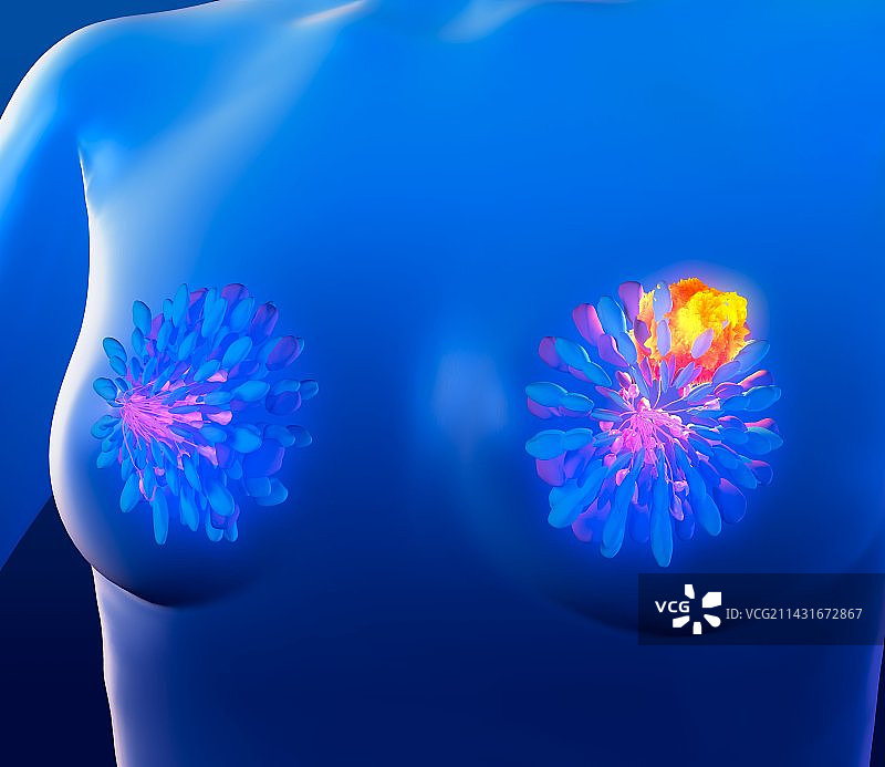 乳腺癌艺术作品图片素材