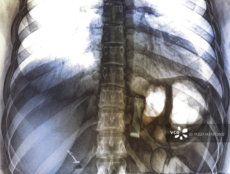 用于治疗肥胖的胃束带图片素材