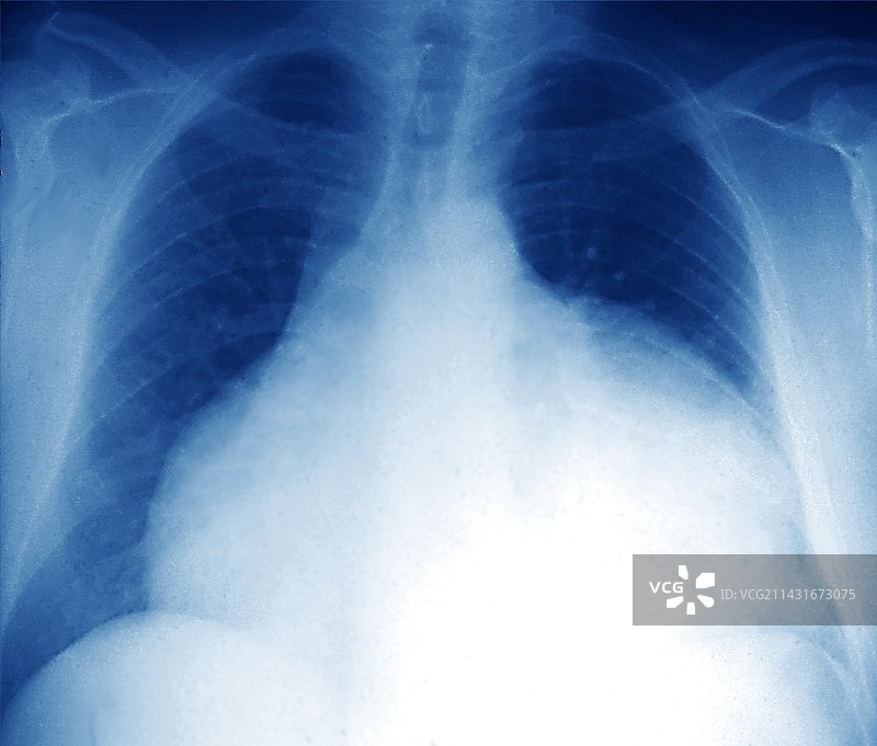心脏扩大X光片图片素材
