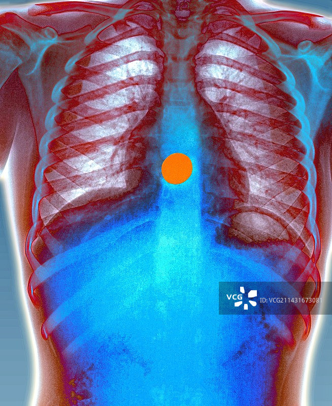 X光下的误吞硬币图片素材