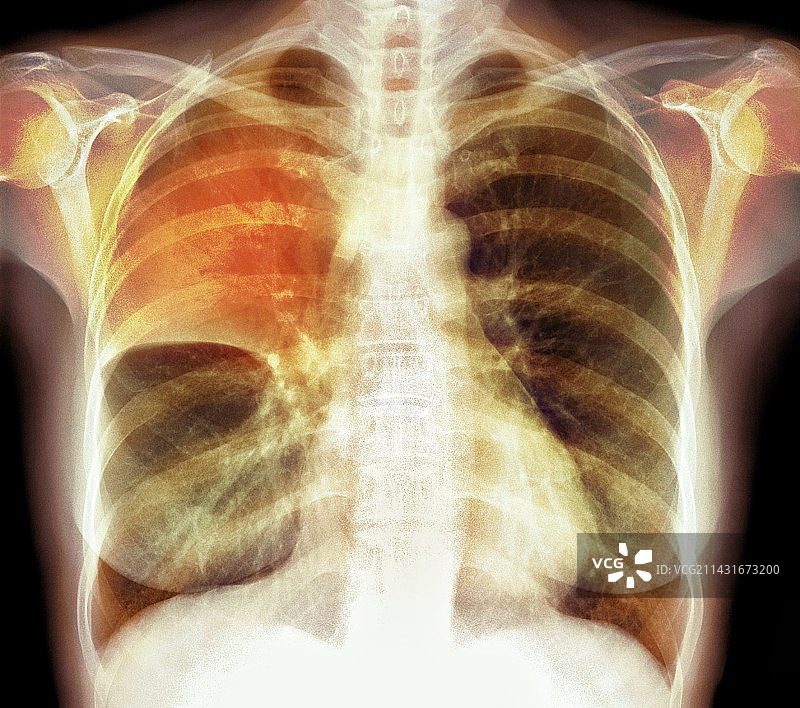肺部实变X光片图片素材