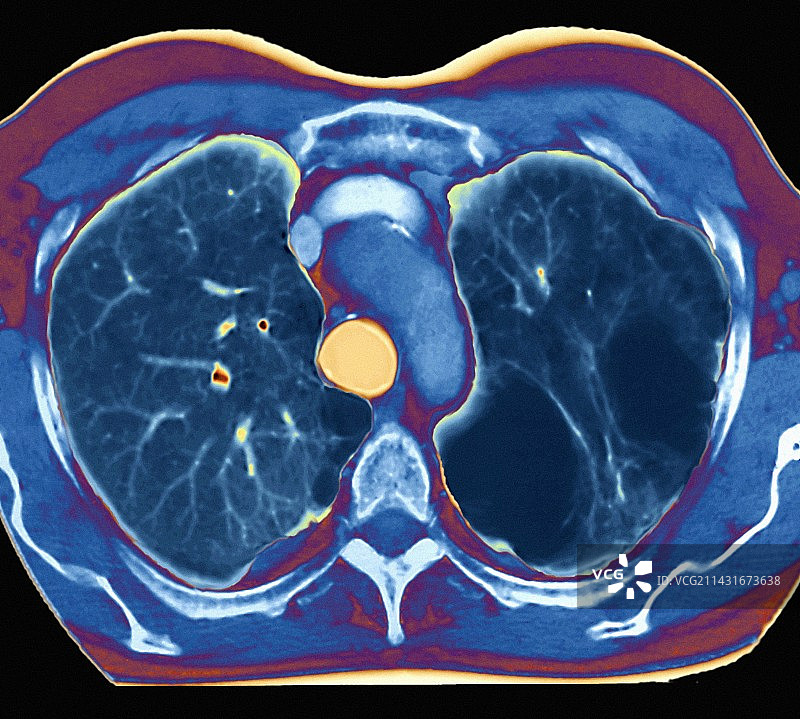肺气肿图片素材