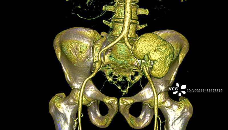 移植肾脏CT扫描图片素材
