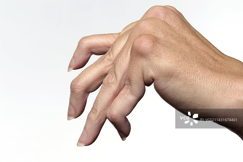 手指类风湿性关节炎图片素材