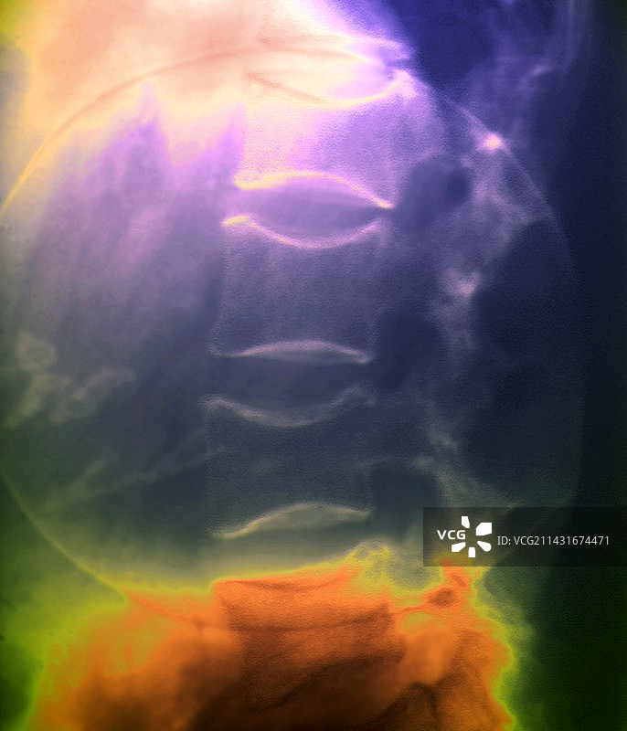 脊柱骨质疏松症X光片图片素材