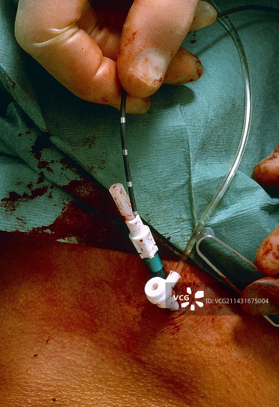 电极和导管特写照片图片素材