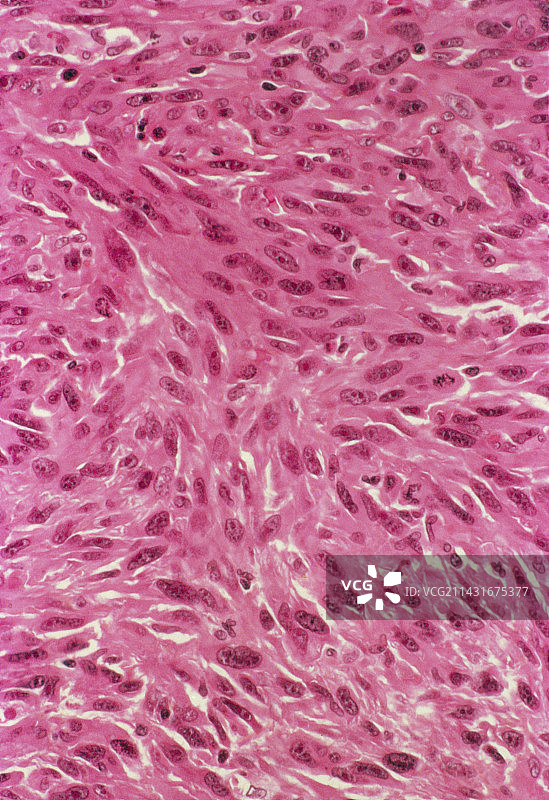 纤维肉瘤，光学显微照片图片素材