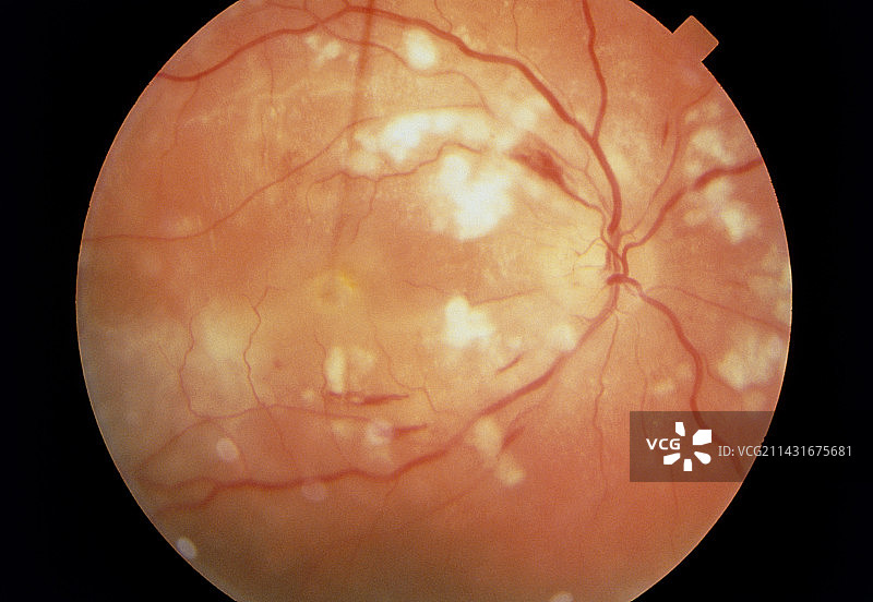 系统性红斑狼疮的眼底镜检查图片素材