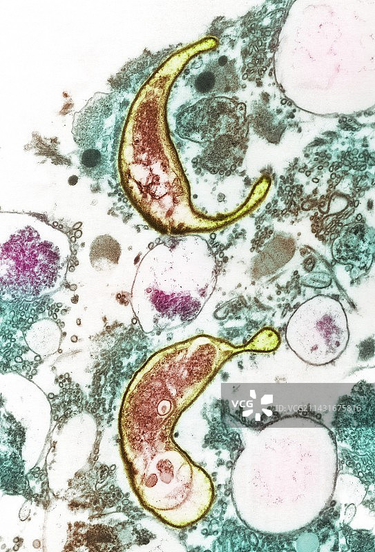 艾滋病肺炎感染,透射电镜图片素材
