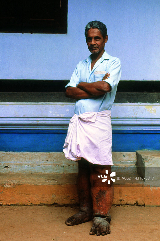 患有丝虫病、腿部象皮病的男人图片素材