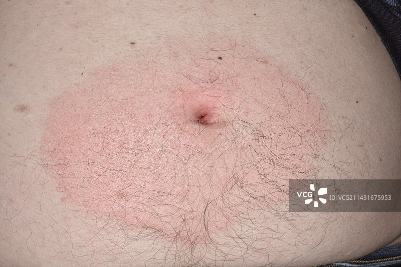 蜱虫叮咬引起的蜂窝组织炎图片素材