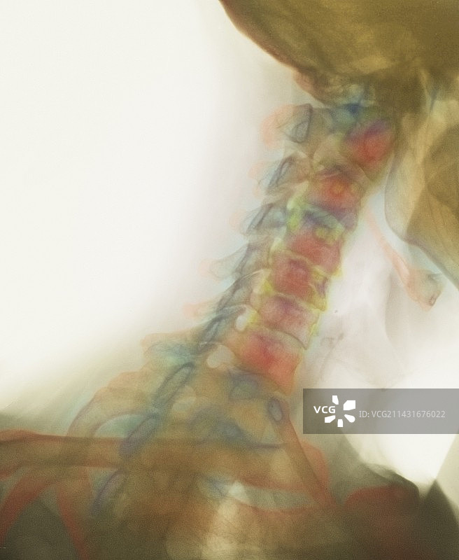 颈椎骨关节炎X光片图片素材