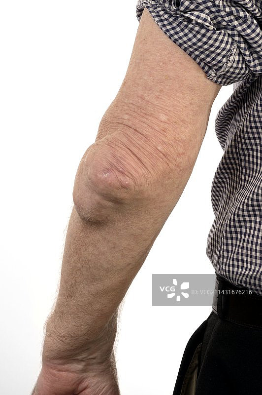 肘部的痛风石图片素材