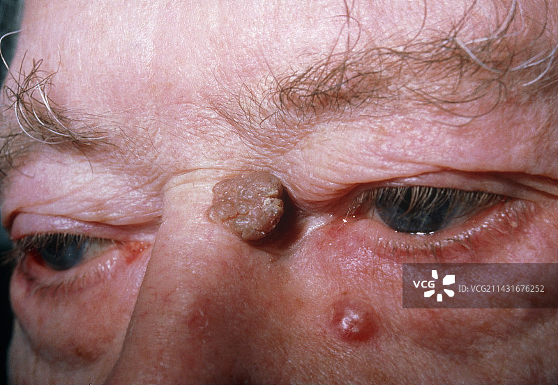基底细胞癌和脂溢性疣图片素材