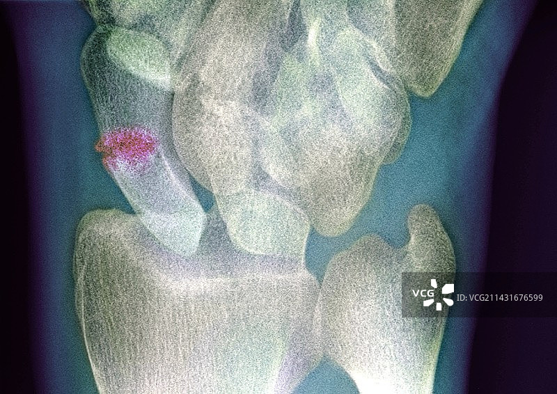 手腕骨折X光片图片素材