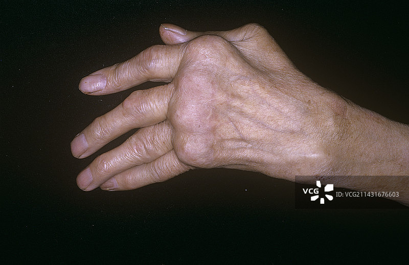 关节炎手部图片素材