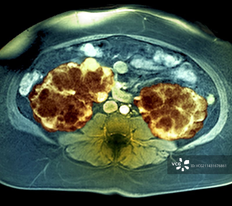 多囊肾核磁共振扫描图片素材
